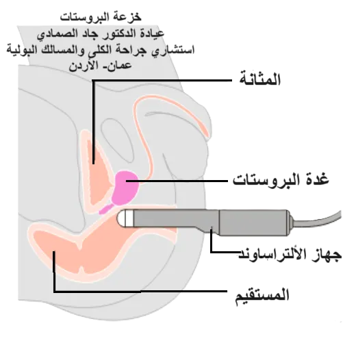      خزعة البروستات الموجَّهة بالموجات فوق الصوتية عبر المستقيم TRUS Prosate Biopsy 